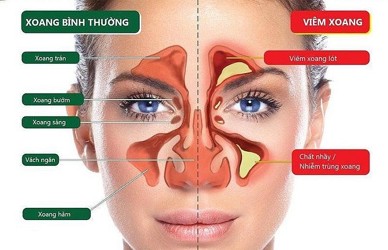 Bạn cần biết gì về bệnh viêm xoang