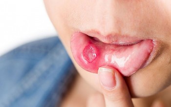 Bỏ túi 5 thói quen ăn uống giúp giảm đau, chữa nhiệt miệng nhanh chóng