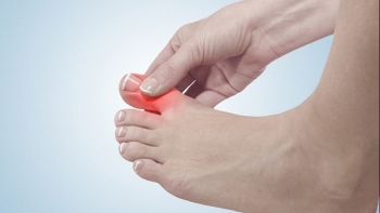 Phòng ngừa bệnh gout hiệu quả nhờ những thói quen này