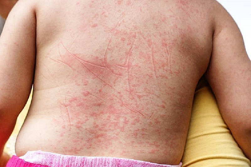 Nổi mẩn đỏ, phát ban là triệu chứng thường gặp của sốt xuất huyết  Nguồn: medlatec.vn