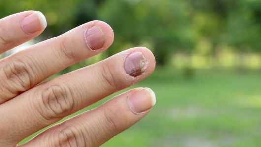 Các bệnh nấm da phổ biến vào mùa mưa