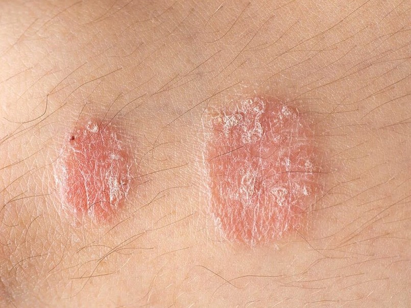 Các bệnh nấm da phổ biến vào mùa mưa