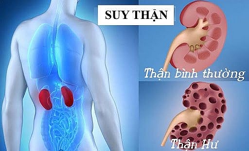 Các thói quen có thể gây suy thận