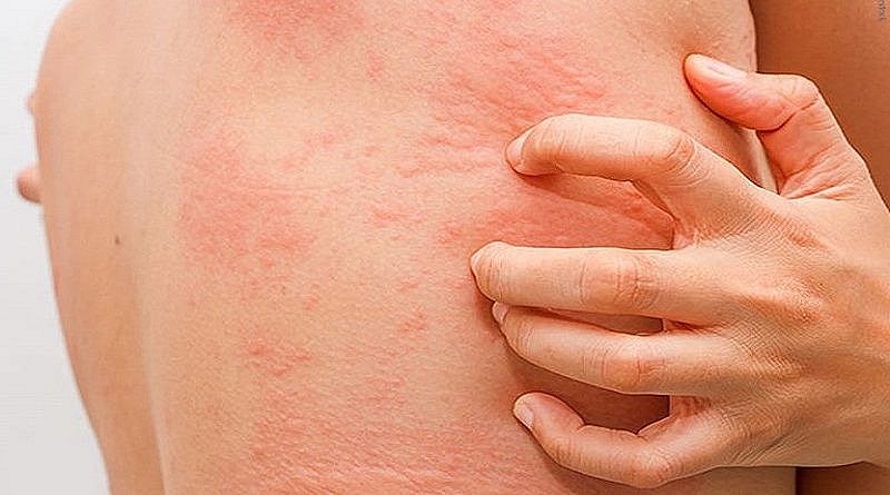 Ngộ độc thực phẩm do Histamine là gì?