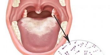 Bệnh bạch hầu lây truyền thế nào?