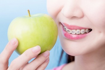 Chế độ ăn lý tưởng cho người đang niềng răng