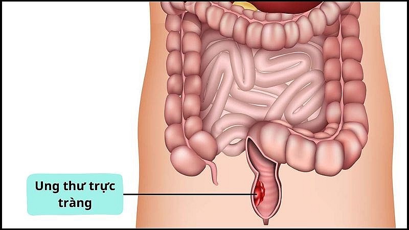 Người mẫu 30 tuổi qua đời vì ung thư trực tràng, căn bệnh này nguy hiểm thế nào?