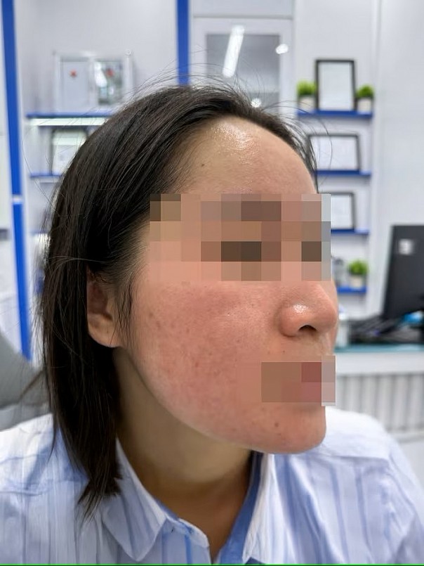 Da mặt cô gái tổn thương nghiêm trọng do dùng chanh trị mụn (Ảnh: BSCC)