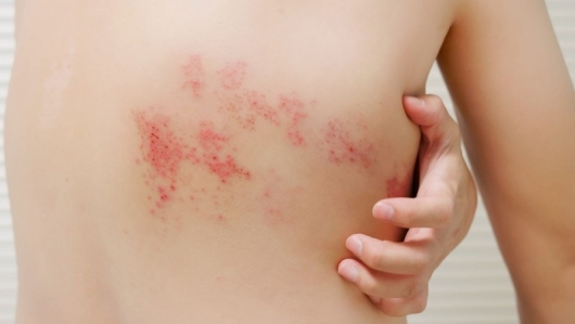Nguy cơ biến chứng nặng từ điều trị zona thần kinh sai cách