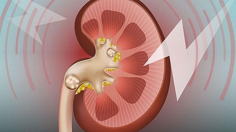 Sỏi thận không còn là nỗi lo nếu bạn ăn đúng loại trái cây này