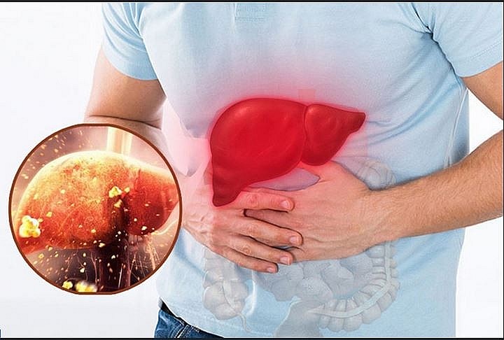 Tình trạng men gan cao xảy ra khi nồng độ các enzym gan vượt mức bình thường