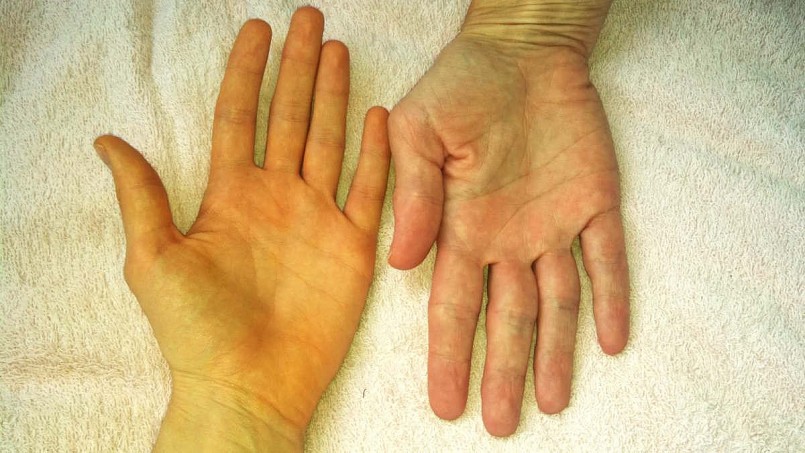 Vàng da, vàng mắt   Đây là biểu hiện rõ rệt nhất khi men gan tăng cao