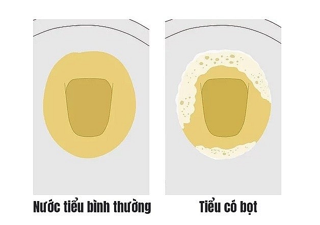 Dấu hiệu lạ trong sinh hoạt hàng ngày có thể cảnh báo suy thận