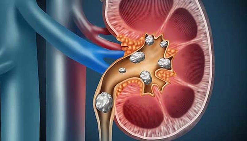 Sỏi thận là bệnh lý phổ biến của hệ tiết niệu.