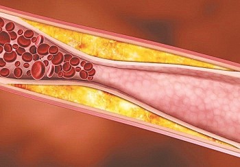 Bác sĩ lý giải vì sao người gầy vẫn mắc mỡ máu cao