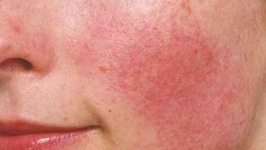 Bí quyết phục hồi da cháy nắng mùa hè tại nhà