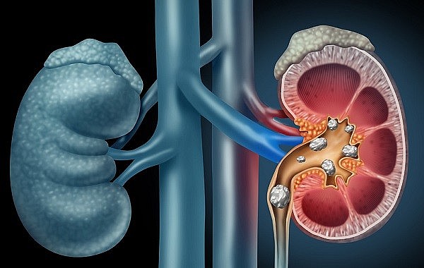 Xung quanh bệnh sỏi thận có rất nhiều thông tin truyền miệng và quan niệm sai lầm.